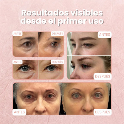 Parches MicroLift™ | Borra Ojeras, Bolsas y Arrugas en 2 Horas